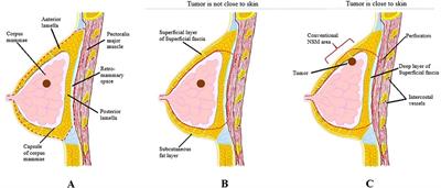 Conventional versus modified nipple sparing mastectomy in immediate breast reconstruction: Complications, aesthetic, and patient-reported outcomes